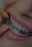 Conventional and Invisible Orthodontics