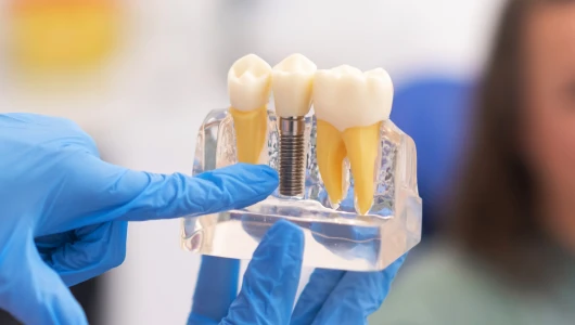 Dental Implants