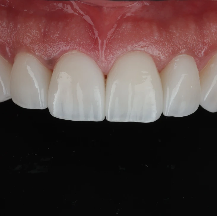 Smile Design with Composite Veneers