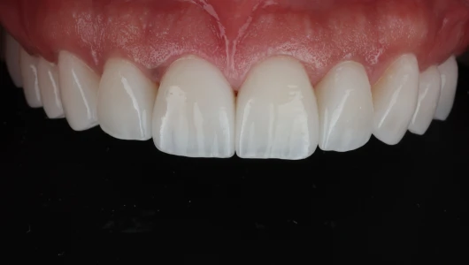Smile Design with Composite Veneers