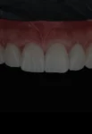 Smile Designs with Composite Veneers