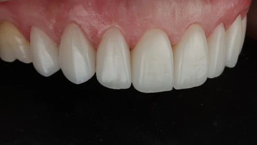 Smile Designs with Porcelain Veneers