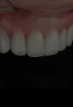 Smile Designs with Porcelain Veneers