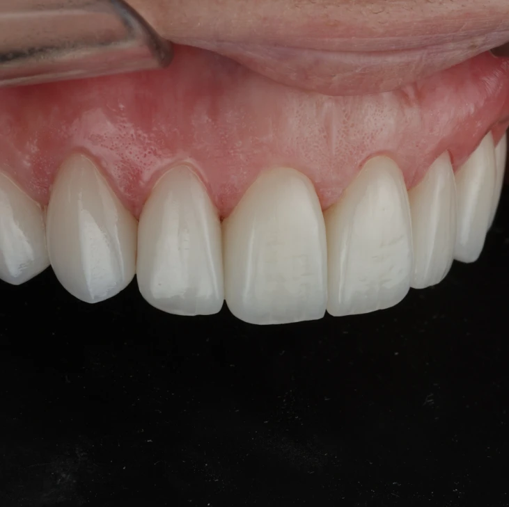Smile Designs with Porcelain Veneers popup